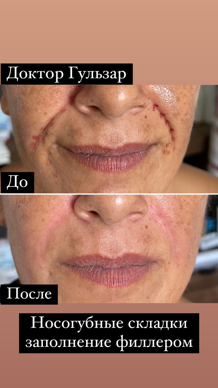 botox tedavi