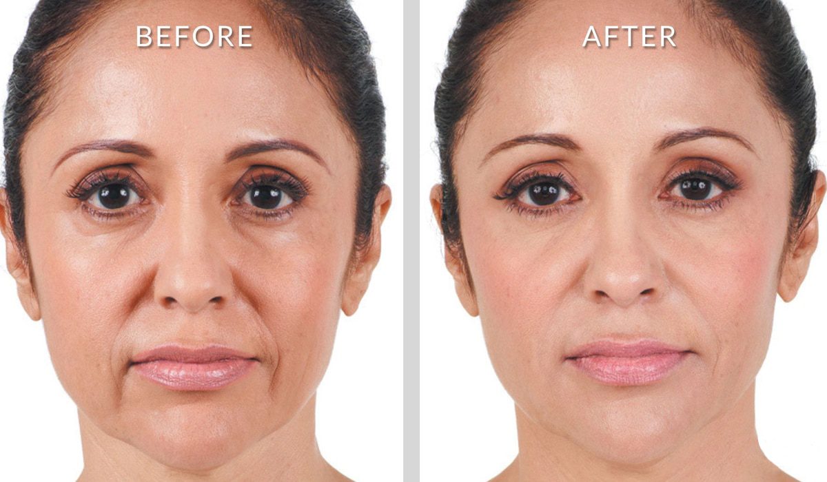botox injection