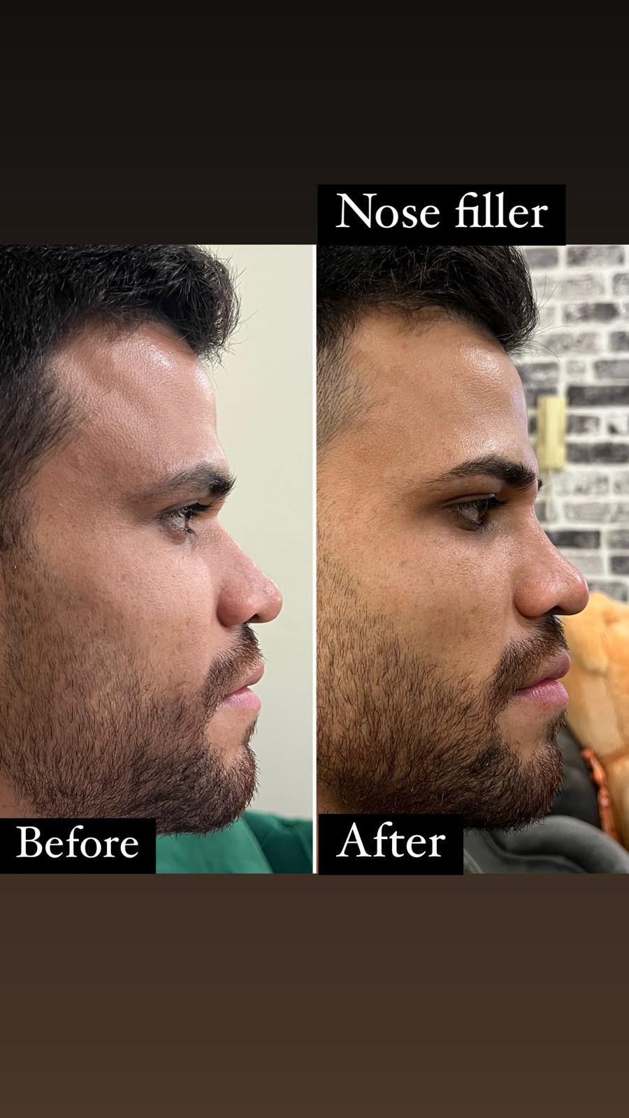 botox tedavi