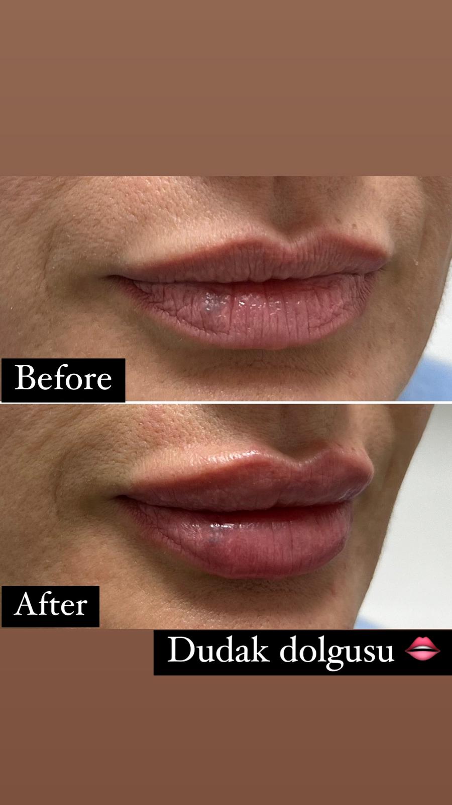 botox tedavi
