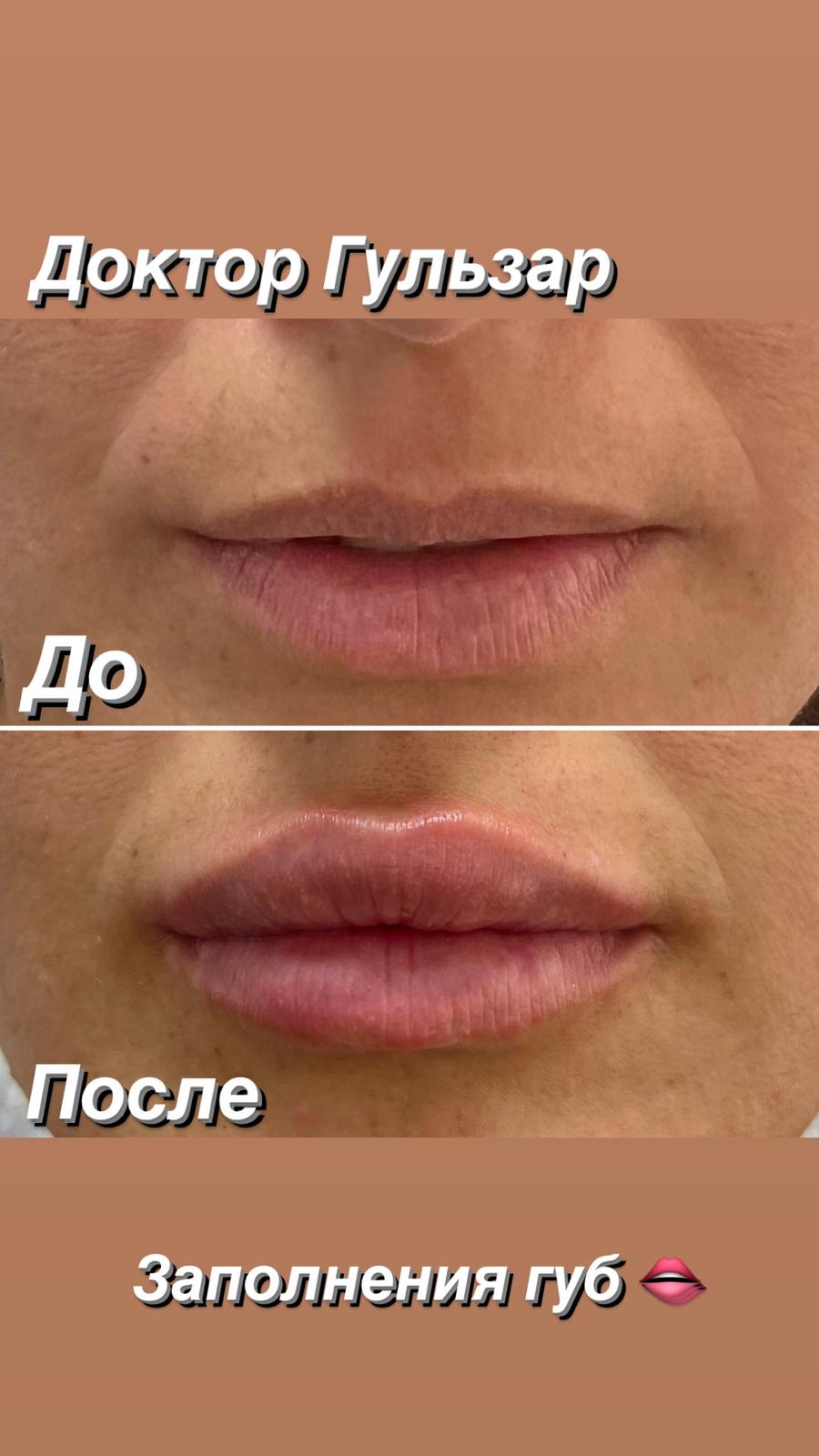 botox tedavi