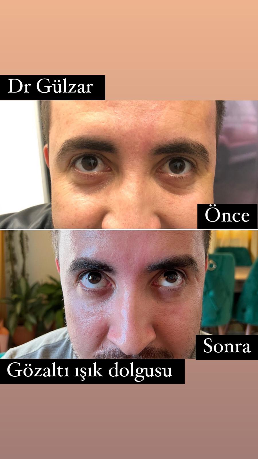 botox tedavi