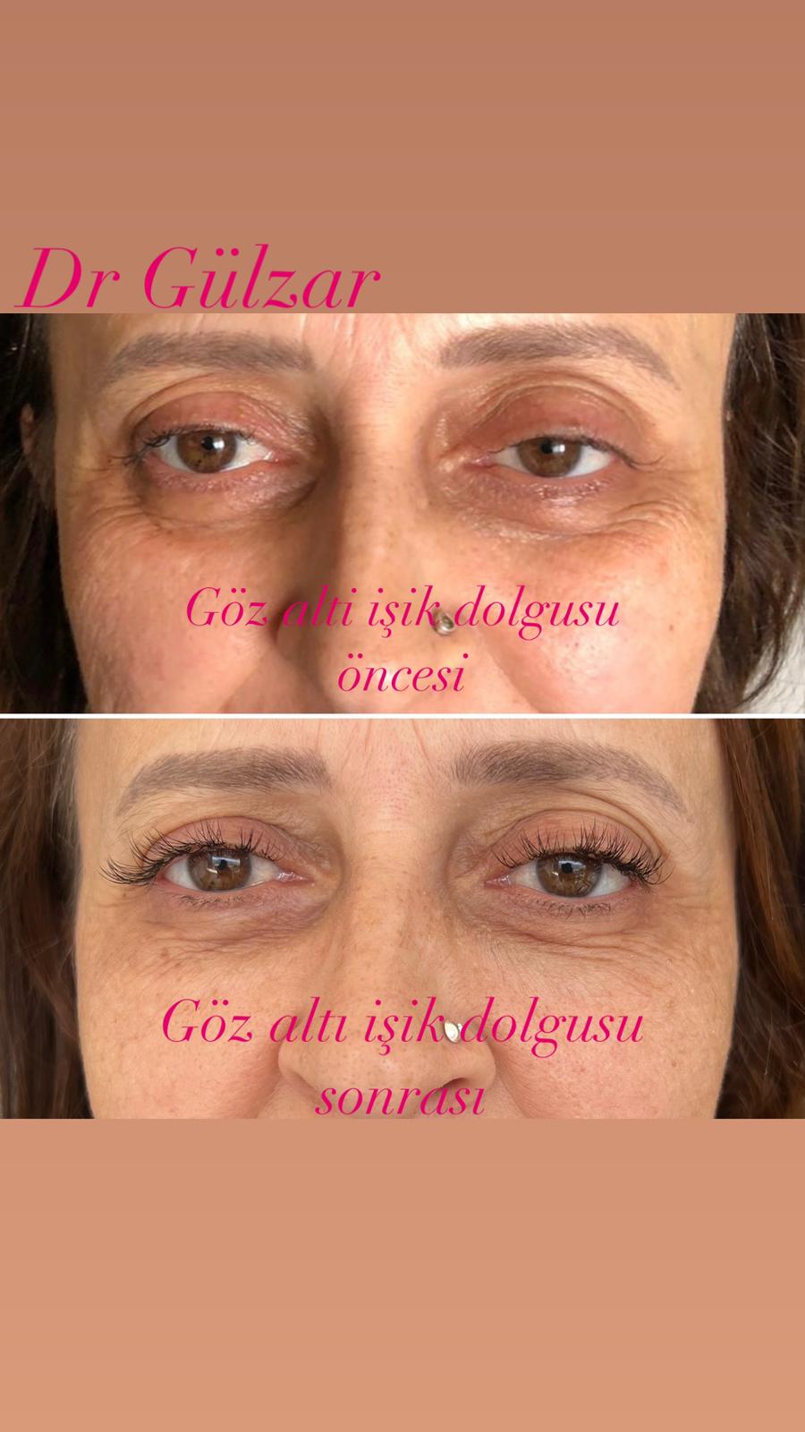 botox tedavi